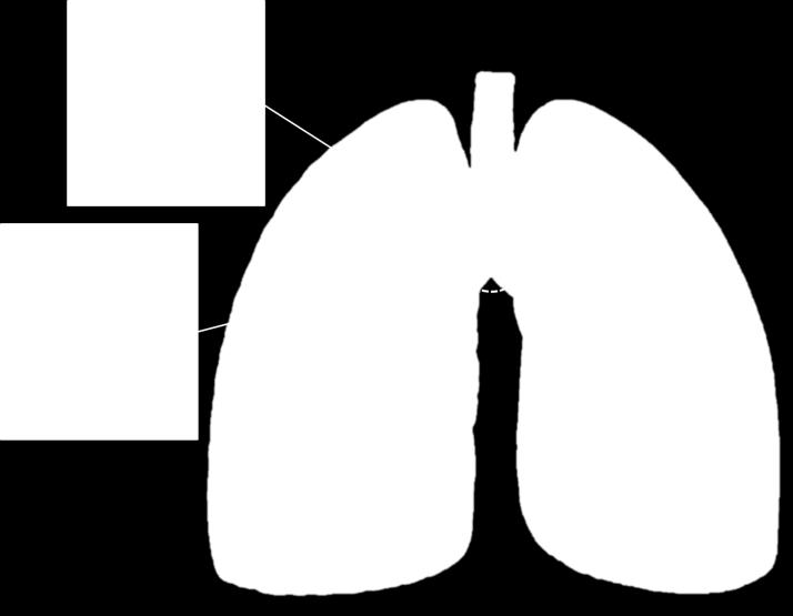 Após um período de 17 dias de internação, a paciente teve alta hospitalar e foi encaminhada para acompanhamento ambulatorial em função da presença da lesão pulmonar atribuída a infecção fúngica