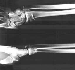 Figura 4 - Fotografia do foco de fratura. Detalhe da comimuição. Figure 4 - Photograph of the fracture. See multi-fragmentation.