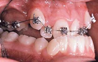 Esta liberação fácil da ligadura também serve para minimizar os movimentos dentários recíprocos adversos (Fig. 1.6).