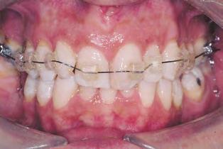 14 Autoligáveis em Ortodontia lingual, por vezes referido como o bráquete de Philippe 35.