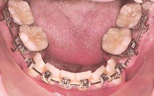 2 Autoligáveis em Ortodontia significativa, mas ao custo de um aumento considerável do atrito (vide infra). Um artigo recente de Khambay et al.