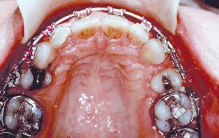 fio de aço. A segunda e bem documentada desvantagem das ligaduras elásticas é a degradação substancial das suas propriedades mecânicas no ambiente oral.