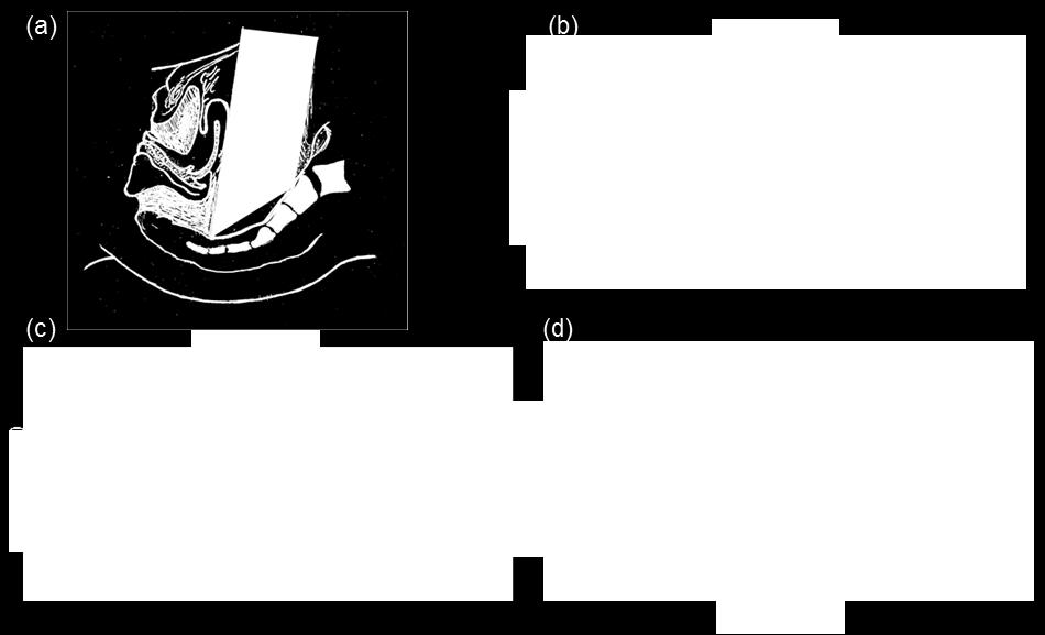 significativamente a distribuição de dose do feixe de eletrões [9]. Figura 1.3 Geometria de irradiação da IOERT em tumores do recto: (a) Esquema do posicionamento de um aplicador com bisel.