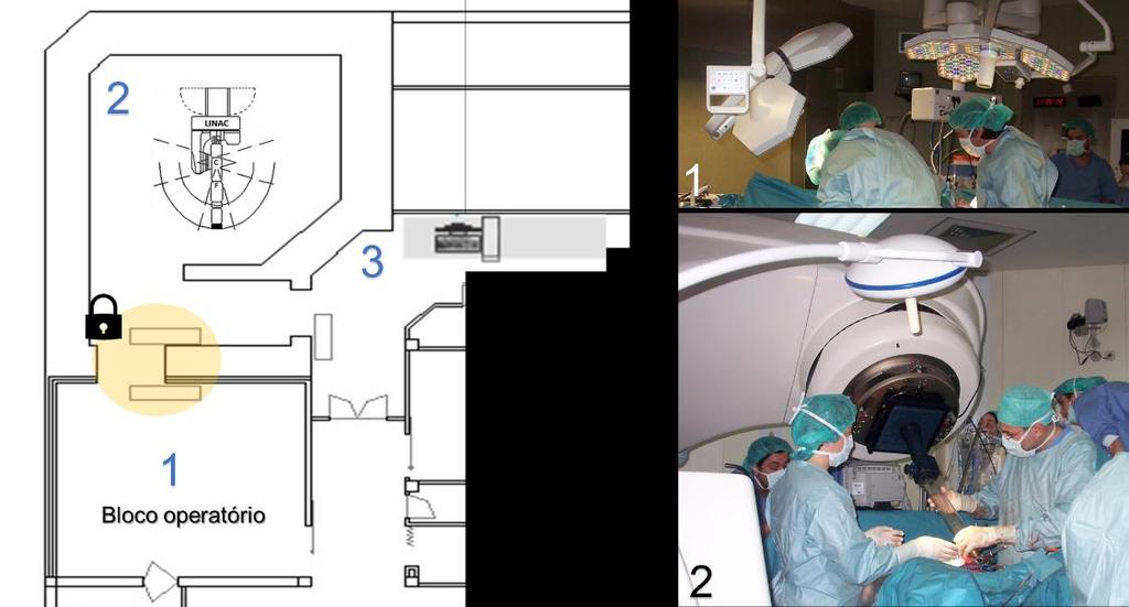 10 Figura 1.4 Esquema do serviço de radioterapia identificando-se: (1) Bloco operatório, (2) Sala de tratamento (bunker) e (3) Zona de controlo do tratamento.