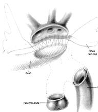 29 Figura 6 A técnica simplificada para perfusão cerebral anterógrada seletiva utilizada em Mount Sinai, mostrando a incorporação dos vasos supra-aórticos. Christian Hagl e M. Arisan Ergin.