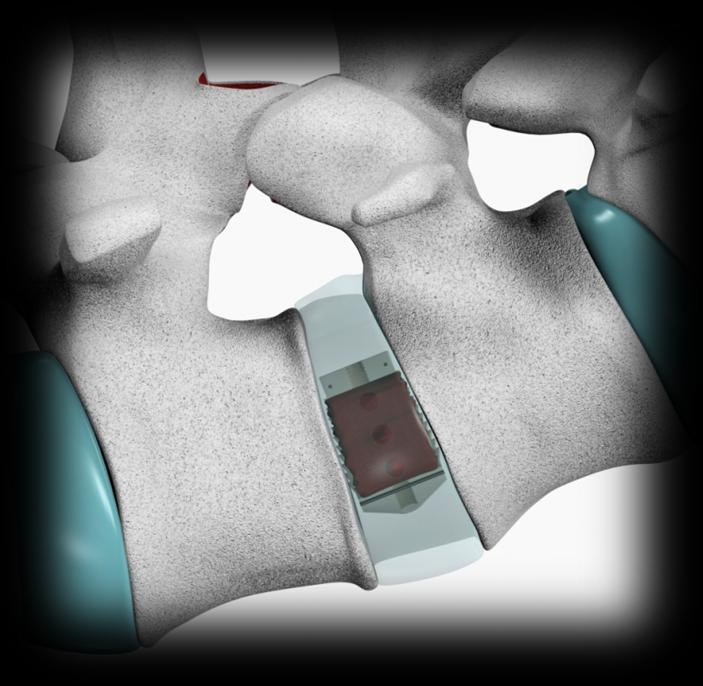 Os dois marcadores de aço inox permitem uma avaliação da posição do implante (Fig.