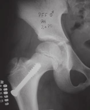 Necrose avascular da cabeça femoral, pseudartrose, coxa vara e fechamento precoce da fise femoral proximal são as mais encontradas na literatura.