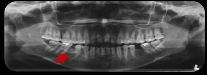 8 Foi solicitada radiografia panorâmica e oclusal. Na radiografia panorâmica foi vista radiopacidade delimitada sobreposta aos dentes 45 e 47 (Fig.