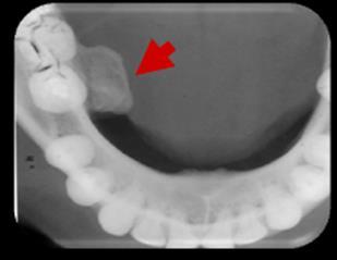 4), com tecido calcificado compatível com formação óssea, de aspecto pediculado, no lado lingual do corpo da mandíbula, com hipótese diagnóstica de osteoma