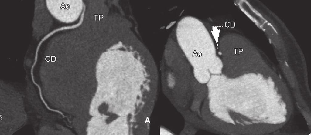 trajeto entre a aorta e o tronco da artéria pulmonar. imagem em mostra, também, o dot sign (seta).