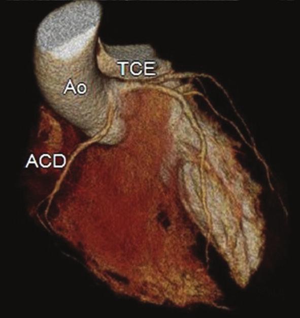 partir do seio coronariano esquerdo, com trajeto entre a aorta e o tronco da pulmonar. CD/ C D Figura 4.