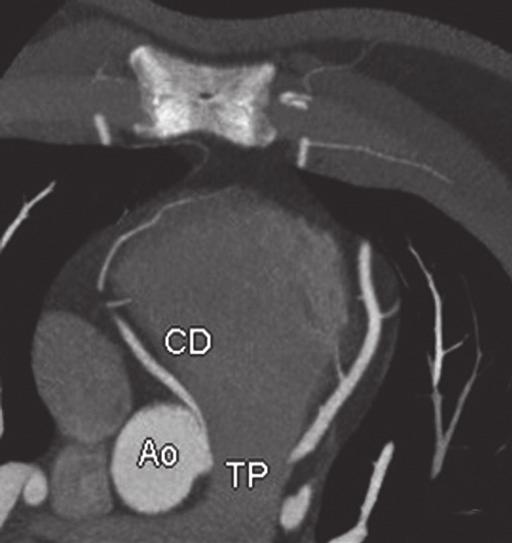 interarterial da artéria coronária direita com origem no seio contralateral (esquerdo) e trajeto entre a aorta e o tronco