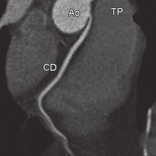 CD, artéria coronária direita; o, aorta; TP, tronco da artéria pulmonar; D, artéria coronária descendente anterior.