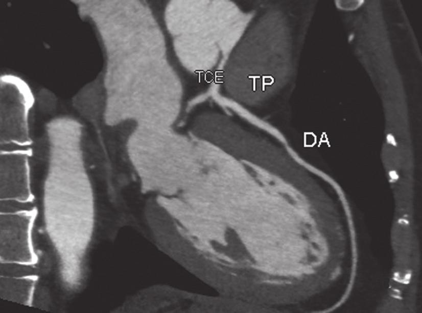 Figura 5. Figura ilustrando os subtipos de curso anômalo interarterial da artéria coronária direita a partir do seio coronariano esquerdo. : Curso interarterial alto.