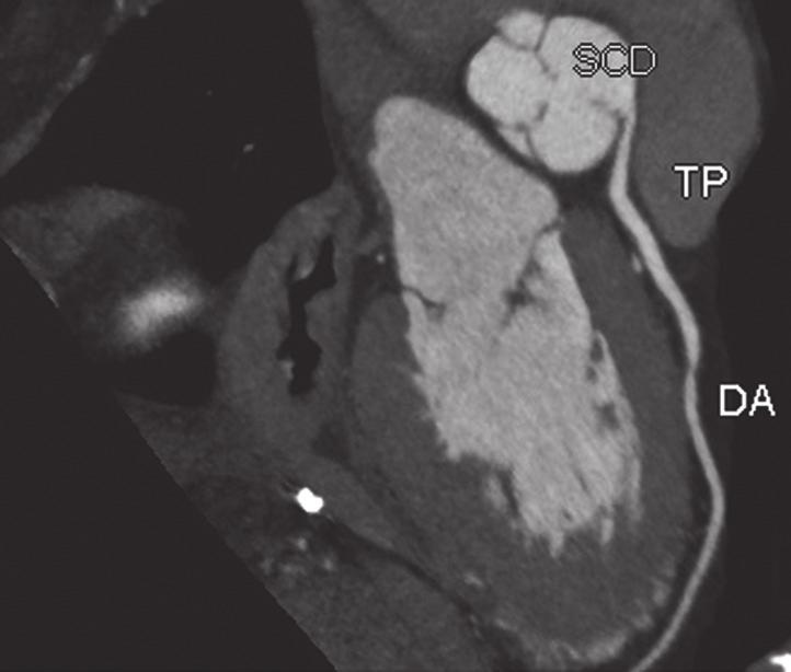 Durante a sístole há distensão simultânea da aorta e da artéria pulmonar, ocasionando a compressão do óstio (formato oval na sístole). : Curso interarterial baixo.