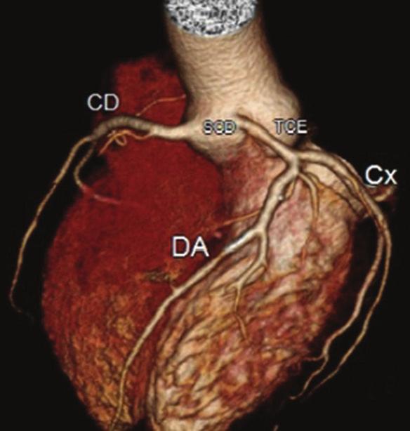 Durante a sístole, a aorta distende, porém, o ventrículo direito contrai, não ocasionando compressão do óstio (bola preta na diástole e na sístole).