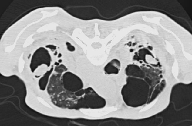 hemoptise há