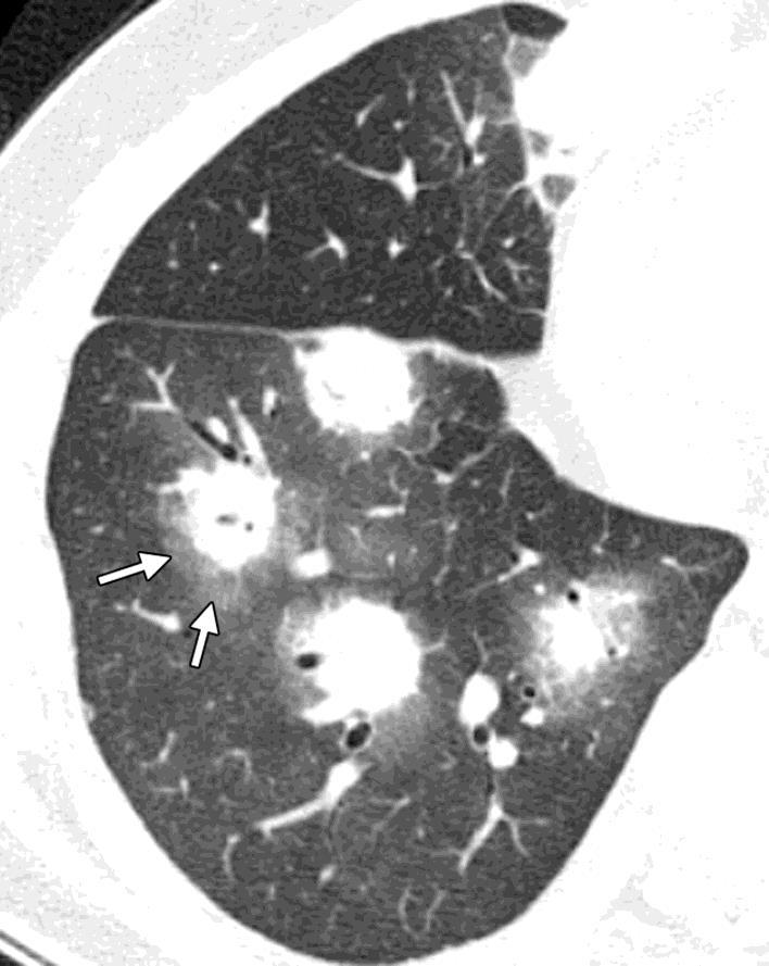 Angioinvasiva Achados tomográficos: Sinal do halo: nódulos envoltos por um halo com atenuação em vidro fosco.