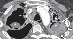 Desai, S.R., Hedayati, V., Patel, K. et al. Eur Radiol (2015) 25: 3100.