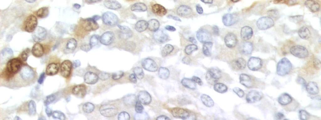 59 A B Figura 10 Meningioma