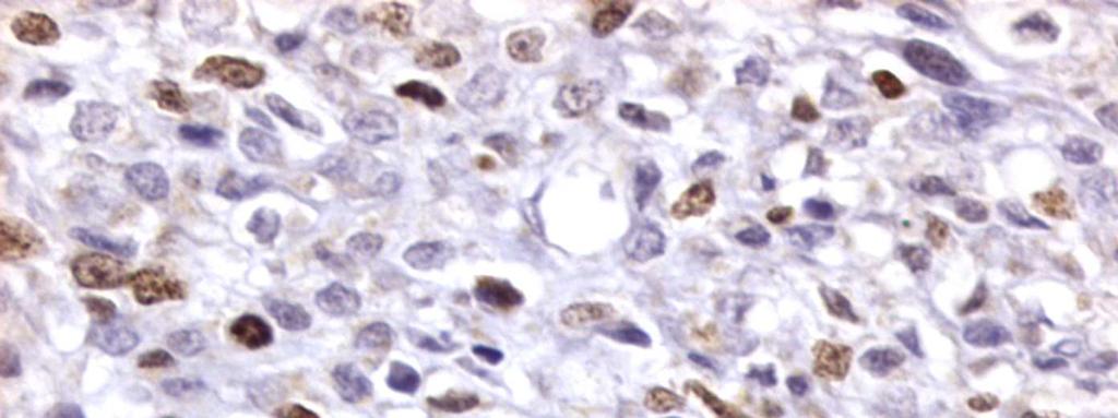 Neuroblastoma olfatório,