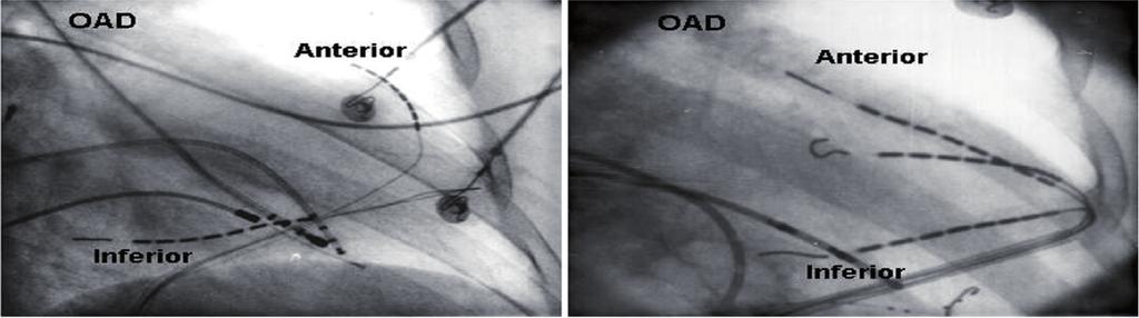 Introdução As arritmias ventriculares são frequentes nas cardiomiopatias com origem não isquêmica, sendo comum a ocorrência de taquicardia ventricular (TV) não sustentada em até 60,0% dos pacientes