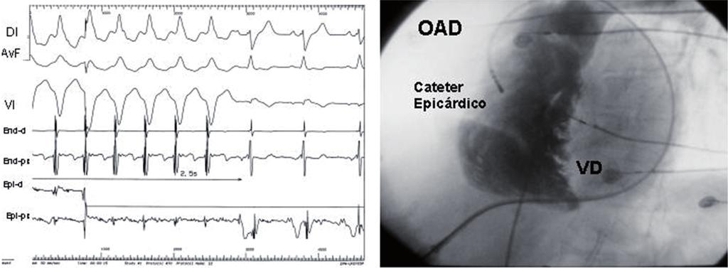 Tabela 1 - Características clínicas dos pacientes incluídos Pt Sexo Idade Cardiopatia Fração de ejeção de VE Classe funcional (NYHA) Morte súbita CDI Dose de amiodarona 1 F 62 Chagásica 53,0% II não