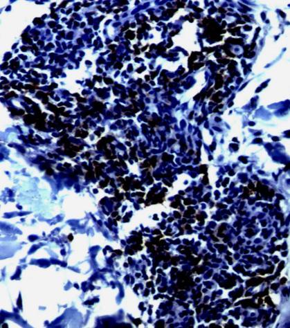 Caso 51: exibiu moderado infiltrado linfocitário em derme superficial de padrão