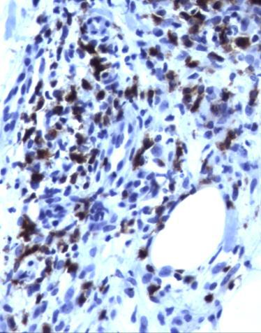 nucleares e epidermotropismo focal, sem indícios de agressão vascular ou anexial e nem