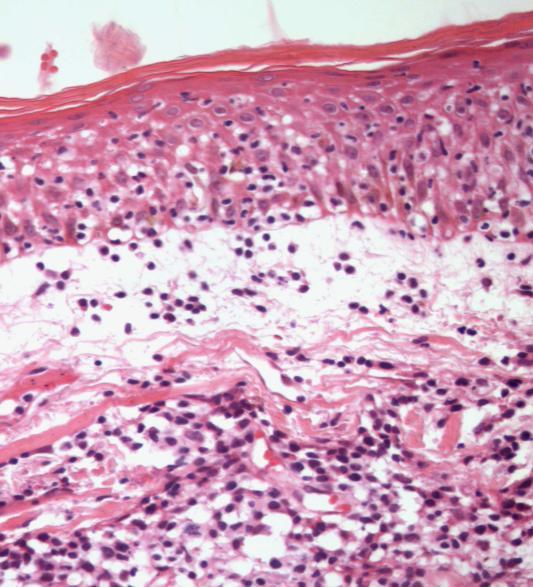 104 B A C D Figura 9: linfoma de células T periféricas sem outra especificação (A)