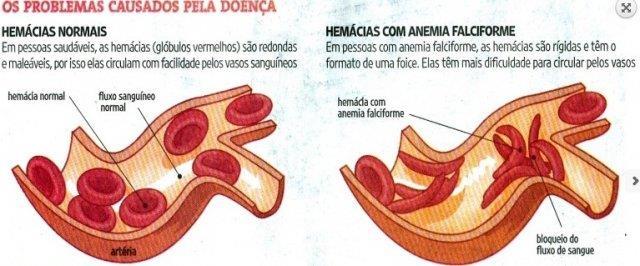 ANEMIA