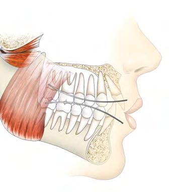 Nesta técnica, o nivelamento é realizado por meio da extrusão de molares e pré-molares e, para evitar que os incisivos inferiores inclinassem para a frente, elásticos de Classe III eram preconizados