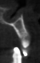 Hellsing 16 relacionou desordens craniomandibulares com maloclusões, como também mostrou que existe uma correlação positiva entre clique da articulação temporomandibular (ATM), desgastes dentários e