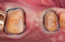 dentina cariada Dentes