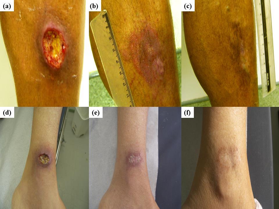 50 FIGURES Figure 1. American cutaneous leishmaniasis (ACL), typical skin lesion: (a) Pretreatment.