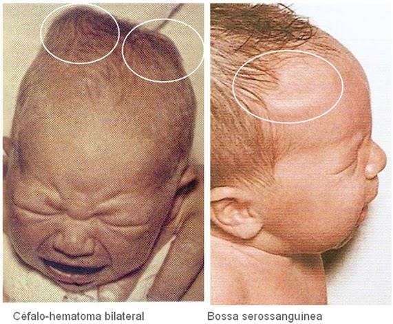 PERÍCIA DO INFANTICÍDIO Durante o trabalho de parto (feto nascente)