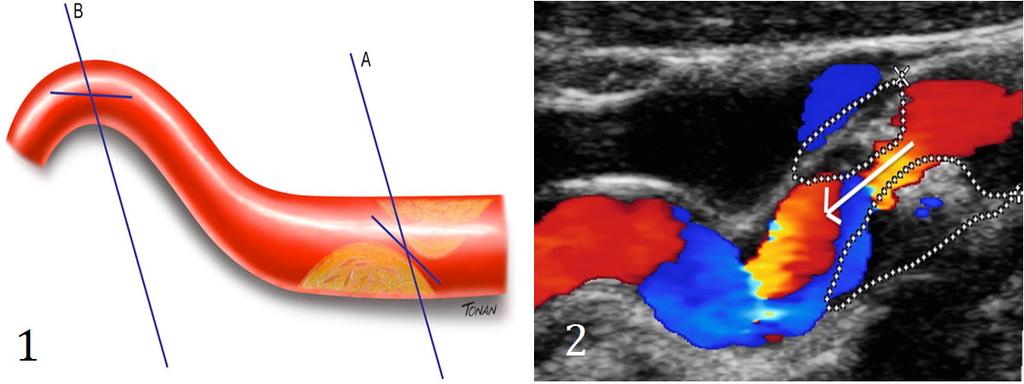 Figura 5 (1) Esquema ilustrando a colocação do cursor e o ângulo de insonação. (A) Paralelo ao jato no caso de estenose. (B) Paralelo ao vaso.