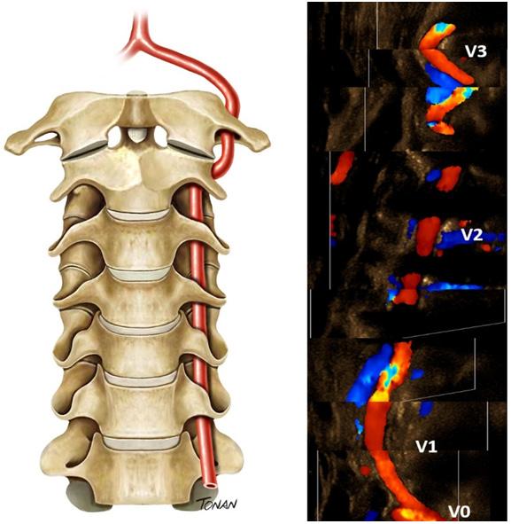 Figura 7 Segmentos extracranianos da artéria vertebral (V0-V3). Para a avaliação da porção extracraniana das artérias vertebrais recomenda-se iniciar o exame pelo segmento V2.