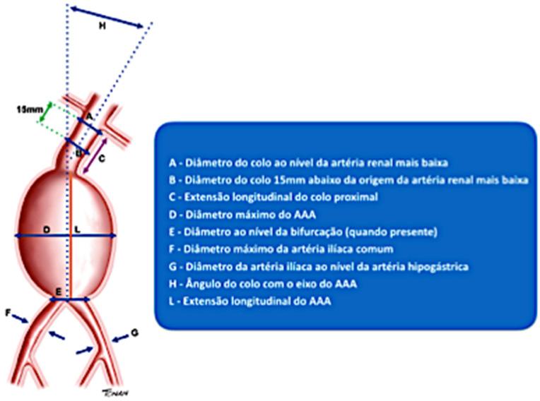 A - Diâmetro do colo ao nível da artéria renal mais baixa B - Diâmetro do colo 15 mm abaixo da origem da artéria renal mais baixa C - Extensão longitudinal do colo proximal D - Diâmetro máximo do AAA