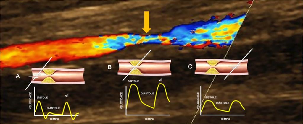 Figura 9 Mapeamento de fluxo em cores demonstrando o fluxo proximal à lesão em vermelho e o fluxo turbilhonado no ponto da lesão (seta). Os esquemas A C mostram o espectro das velocidades ao Doppler.