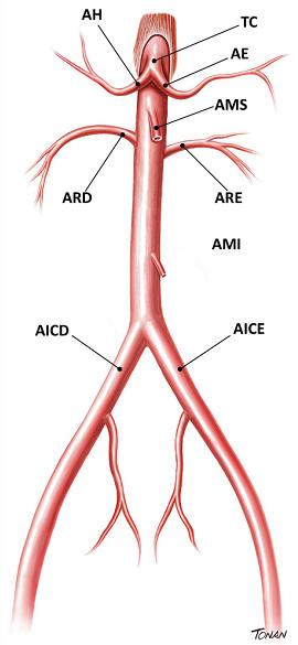 Tabela 12 Limitações do exame de ultrassonografia vascular na avaliação de aorta abdominal e ramos.