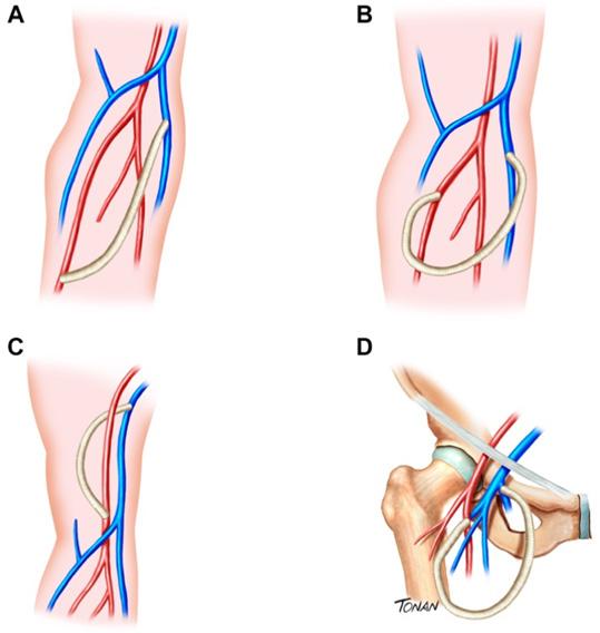 (D) Posição terminoterminal artéria e veia. Figura 13 Tipos de fístulas de politetrafluoretileno (PTFE).