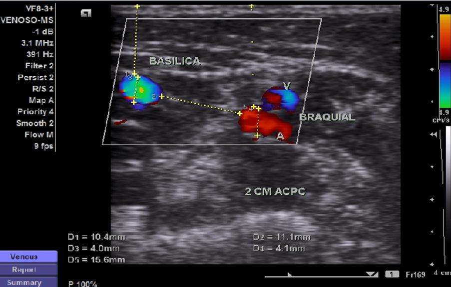 Figura 14 Medida da distância entre a artéria braquial e a veia basílica pré-confecção de fístulas arteriovenosas alternativa.