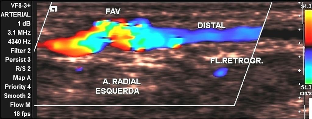 Figura 15 Fenômeno de roubo com fluxo retrógrado na artéria radial (em azul), no segmento distal à anastomose da fístulas arteriovenosas para hemodiálise.