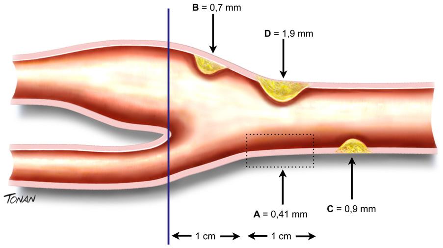 documentos de consenso de Mannheim 2004-2011 9 e do consenso da American Society of Echocardiography, 10 os especialistas brasileiros na área da US vascular se mobilizaram para difundir a prática