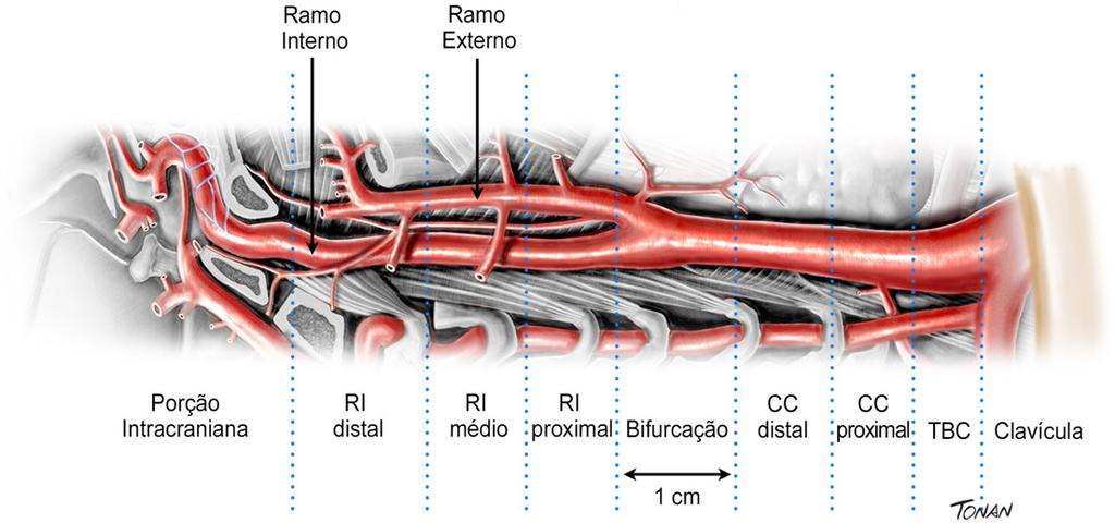 Figura 2 Carótida direita e suas subdivisões anatômicas recomendadas pelo grupo (adaptada do estudo Mannheim). 9 CC: carótida comum; RI: ramo interno; TBC: tronco braquicefálico.