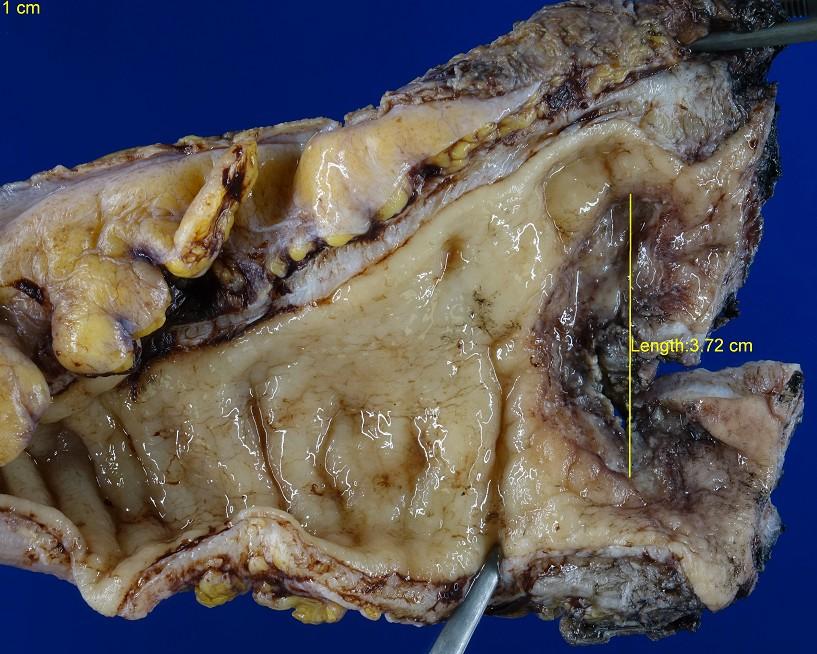 Margens Retossigmoidectomia A não realização de cirurgias