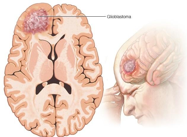 Neurocirurgia Biópsias