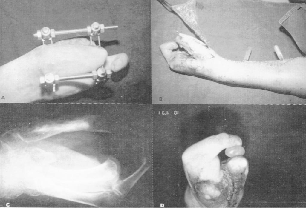 S. RIBAK, M.R. RESENDE & R. DALAPRIA Fig. 3 a) Alongamento máximo, pré-enxertia.