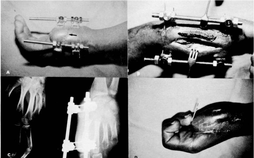 RECONSTRUÇÃO DOS RAIOS DIGITAIS PELO PRINCÍPIO DE ALONGAMENTO-DISTRAÇÃO NA MÃO ACIDENTADA Fig. 5 a) Início do alongamento. Nota-se a incisão pós-osteotomia do primeiro metacarpo (seta).